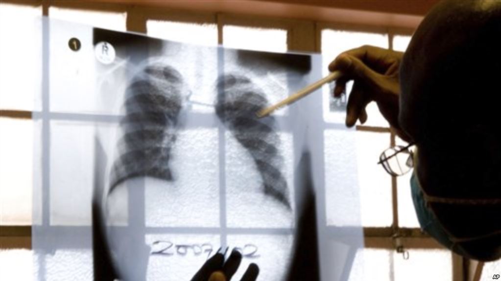 Lesotho Urged to Intensify Fight Against Tuberculosis Amid Persistent High Burden